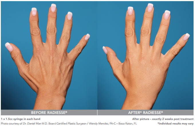 radiesse